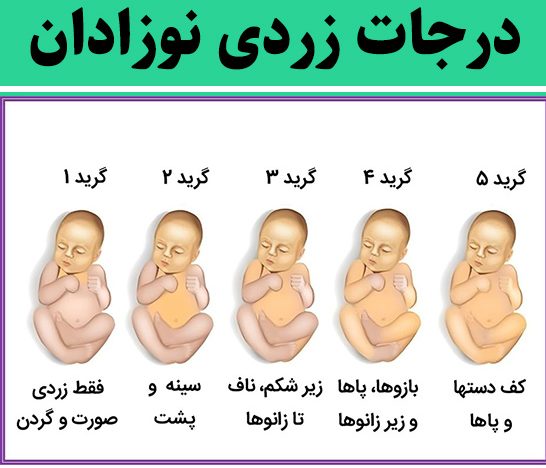 زردی نوزادان چیست و دلایل آن